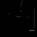 Neonatal neuroblastoma (Radiopaedia 56651-63438 Coronal non-contrast 56).jpg