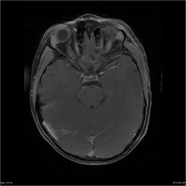 File:Neurofibromatosis type 1 (Radiopaedia 22541-22564 Axial T1 C+ fat sat 24).jpg