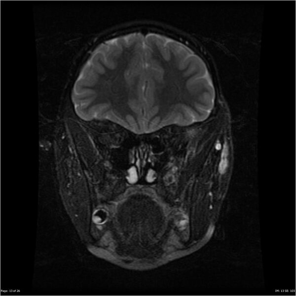 File:Neurofibromatosis type 1 (Radiopaedia 22541-22564 Coronal T2 fat sat 4).jpg