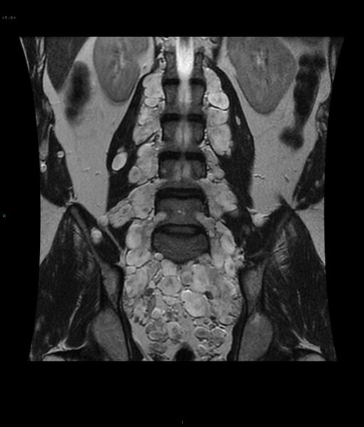 File:Neurofibromatosis type 1 (Radiopaedia 36933-38560 Coronal T2 9).jpg
