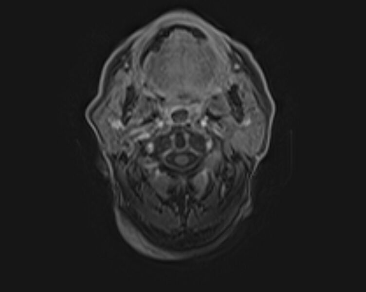 File:Non-Hodgkin lymphoma - parotid gland (Radiopaedia 71531-81890 E 38).jpg
