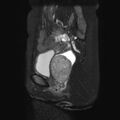 Non-puerperal uterine inversion (Radiopaedia 78343-90983 Sagittal T2 fat sat 17).jpg