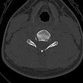 Normal CT of the cervical spine (Radiopaedia 53322-59305 Axial bone window 167).jpg