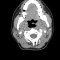 Normal CT of the neck (Radiopaedia 14575-14500 Axial C+ 27).jpg