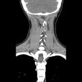Normal CT of the neck (Radiopaedia 14575-14500 Coronal C+ 43).jpg