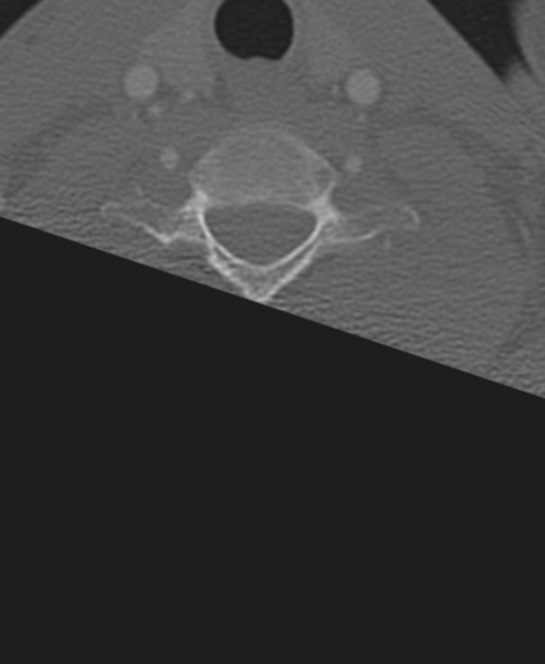 File:Normal CT thoracic spine (Radiopaedia 40181-42688 Axial bone window 3).png