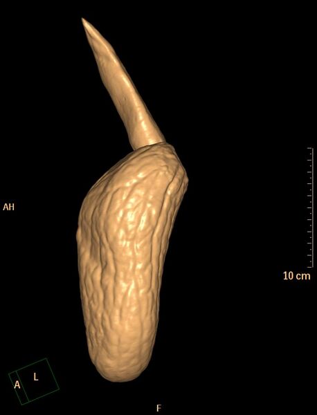 File:Normal CT virtual gastroscopy (Radiopaedia 29960-30501 3D VG 5).jpg