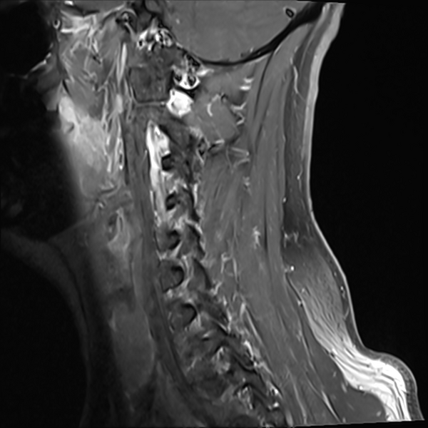 File:Normal MRI cervical spine (infection protocol) (Radiopaedia 53916-60039 I 2).png