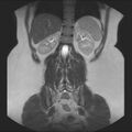 Normal liver MRI with Gadolinium (Radiopaedia 58913-66163 Coronal T2 31).jpg
