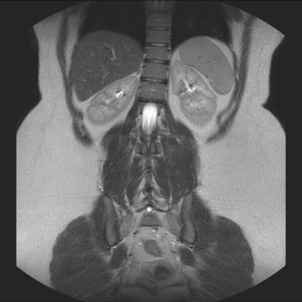 File:Normal liver MRI with Gadolinium (Radiopaedia 58913-66163 Coronal T2 31).jpg