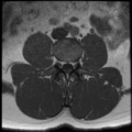 Normal lumbar spine MRI (Radiopaedia 35543-37039 Axial T1 23).png