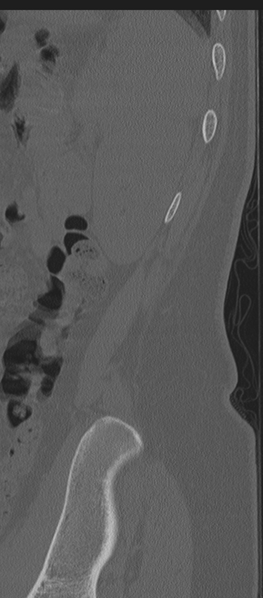 File:Normal lumbosacral CT (Radiopaedia 37923-39867 Sagittal bone window 4).png