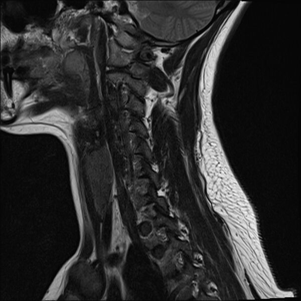 File:Normal trauma cervical spine MRI (Radiopaedia 32130-33071 Sagittal T2 13).jpg