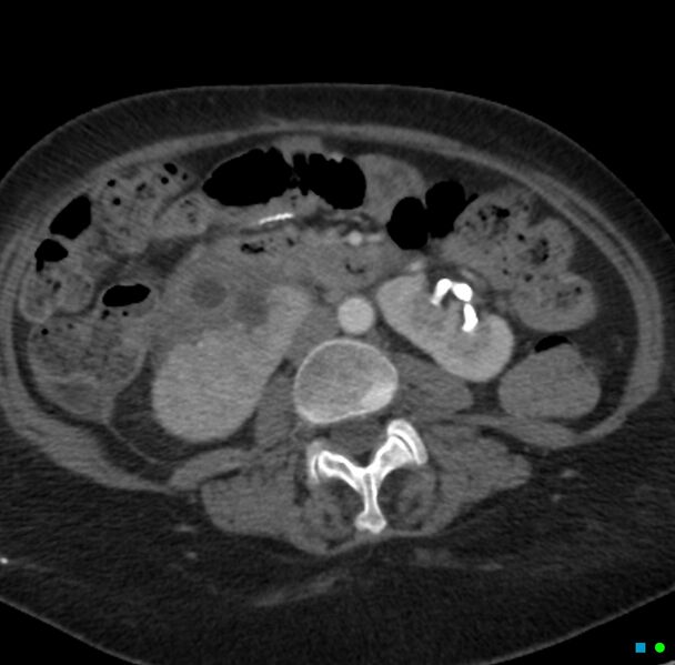 File:Obstructed infected horseshoe kidney (Radiopaedia 18116-17898 B 15).jpg