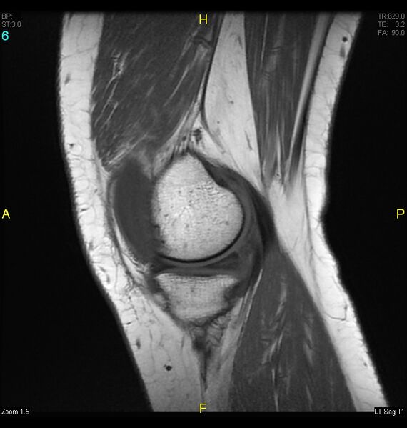 File:ACL mucoid degeration with cystic changes (Radiopaedia 48428-53341 Sagittal T1 4).jpg