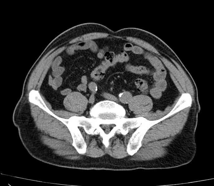 File:Abdominal aortic aneurysm (Radiopaedia 22421-22458 non-contrast 39).jpg