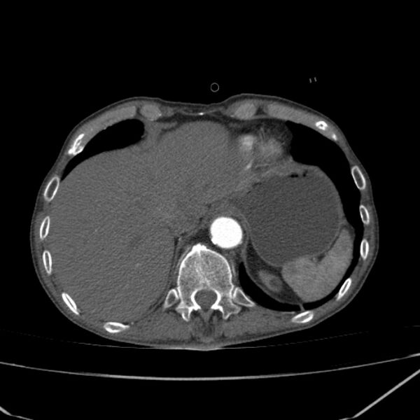 File:Abdominal aortic aneurysm (Radiopaedia 23703-23856 Axial C+ arterial phase 5).jpg