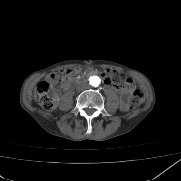File:Abdominal aortic aneurysm (Radiopaedia 23703-23856 Axial C+ arterial phase 53).jpg