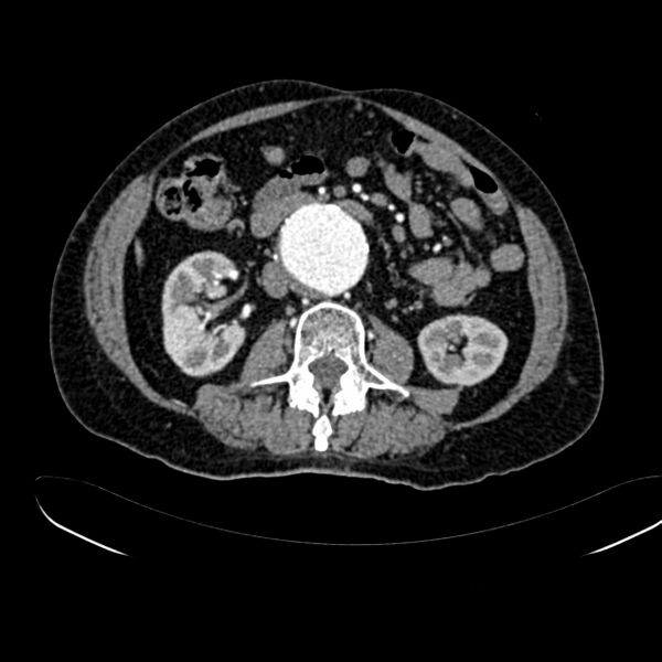 File:Abdominal aortic aneurysm (Radiopaedia 75131-86203 Axial C+ arterial phase 23).jpg