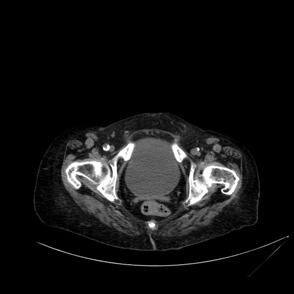 File:Abdominal aortic aneurysm - impending rupture (Radiopaedia 19233-19246 Axial non-contrast 122).jpg