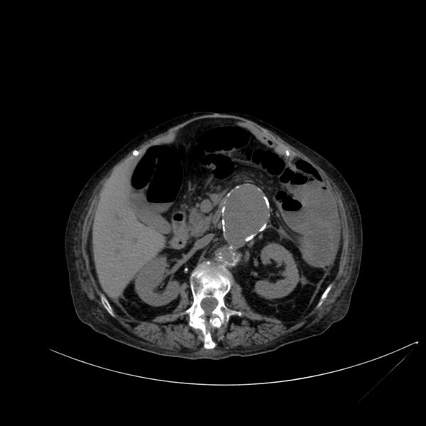 File:Abdominal aortic aneurysm - impending rupture (Radiopaedia 19233-19246 Axial non-contrast 53).jpg