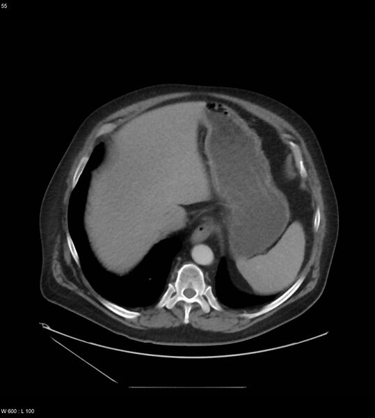 File:Abdominal aortic aneurysm with intramural hematoma then rupture (Radiopaedia 50278-55631 Axial C+ arterial phase 46).jpg