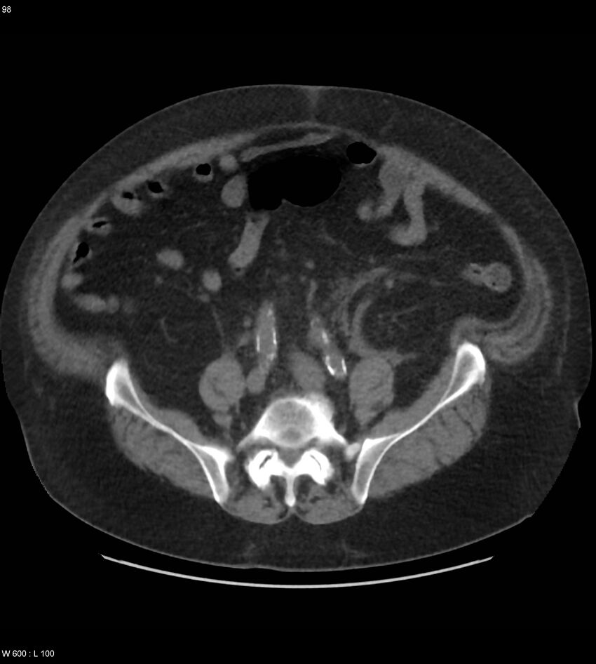 Abdominal aortic aneurysm with intramural hematoma then rupture (Radiopaedia 50278-55631 Axial non-contrast 94).jpg