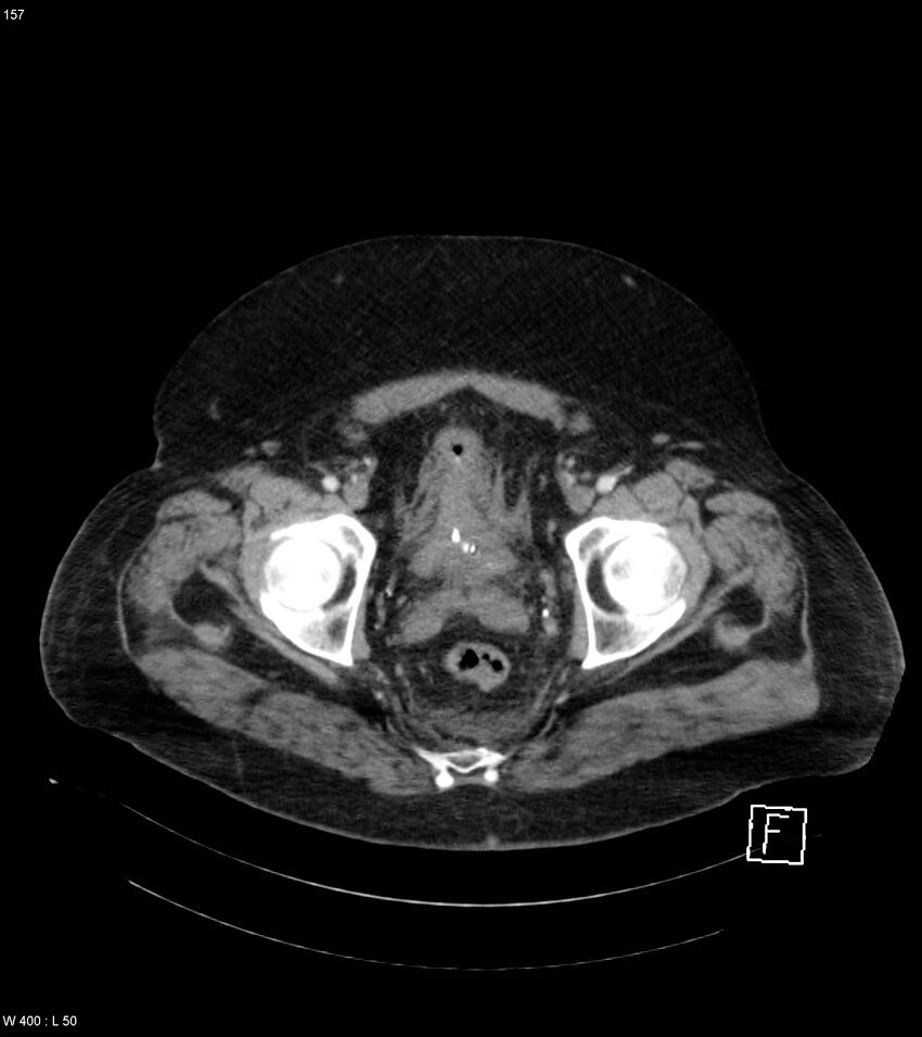 Abdominal aortic aneurysm with intramural hematoma then rupture (Radiopaedia 50278-55632 Axial C+ arterial phase 156).jpg
