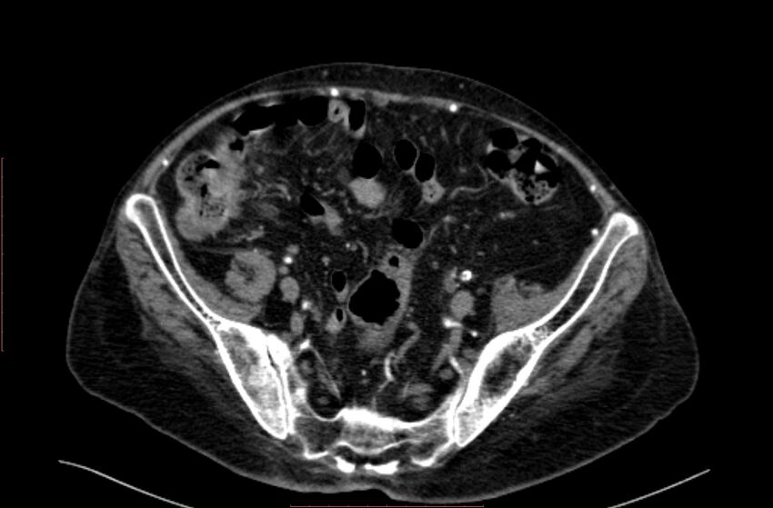 Abdominal aortic interposition tube graft and aneurysm thrombosis (Radiopaedia 71438-81857 Axial C+ arterial phase 174).jpg