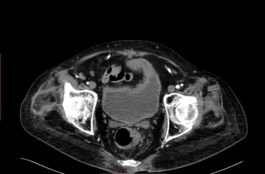 Abdominal aortic interposition tube graft and aneurysm thrombosis (Radiopaedia 71438-81857 Axial C+ arterial phase 217).jpg