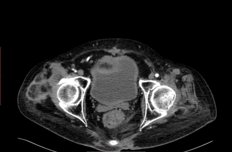 File:Abdominal aortic interposition tube graft and aneurysm thrombosis (Radiopaedia 71438-81857 Axial C+ arterial phase 225).jpg