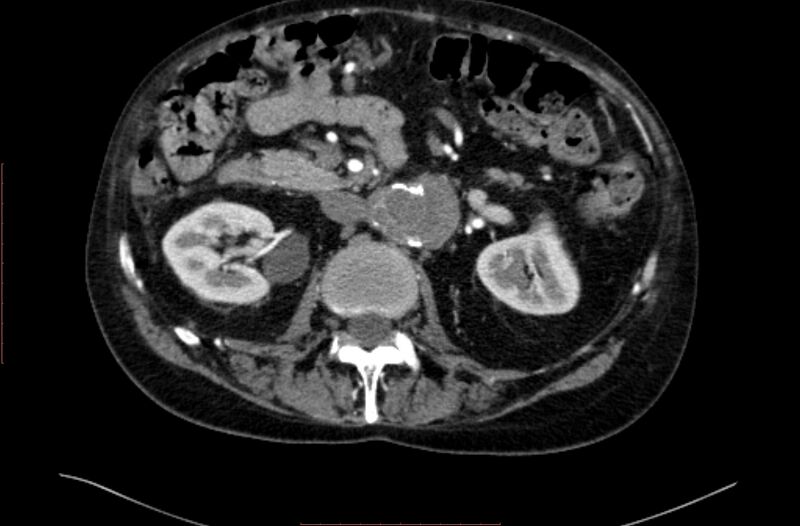 File:Abdominal aortic interposition tube graft and aneurysm thrombosis (Radiopaedia 71438-81857 Axial C+ arterial phase 55).jpg