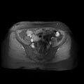 Abdominal wall endometriosis (Radiopaedia 83702-98847 Axial T1 C+ fat sat 22).jpg