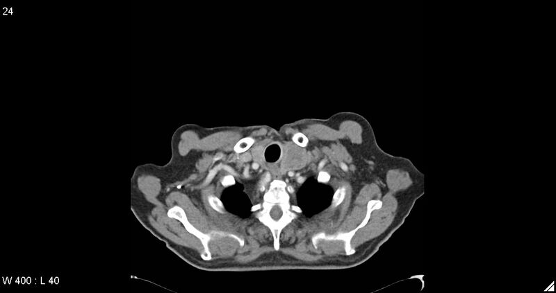 File:Aberrant right subclavian artery aneurysm (Radiopaedia 13747-13631 Axial C+ arterial phase 1).jpg