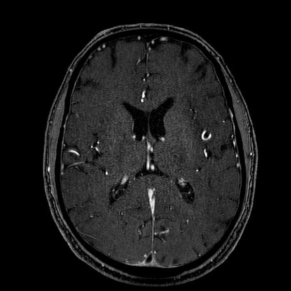 File:Accessory middle cerebral artery (Radiopaedia 73114-83828 Axial MRA 118).jpg