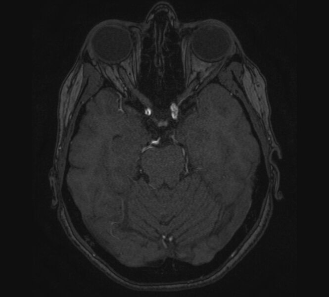 File:Accessory middle cerebral artery and ICA aneurysm (Radiopaedia 22656-22674 MRA 36).jpg