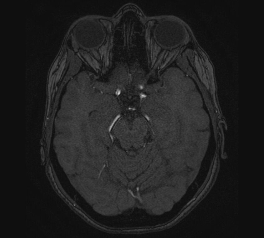 Accessory middle cerebral artery and ICA aneurysm (Radiopaedia 22656-22674 MRA 41).jpg