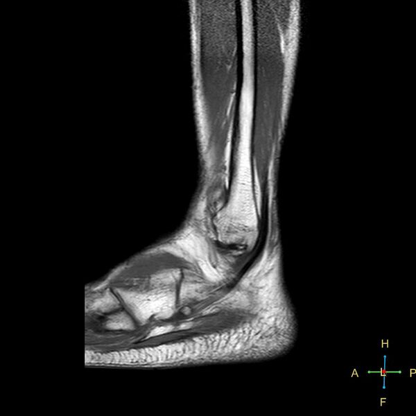 File:Achilles tendon complete tear (Radiopaedia 22834-22854 Sagittal T1 2).jpg