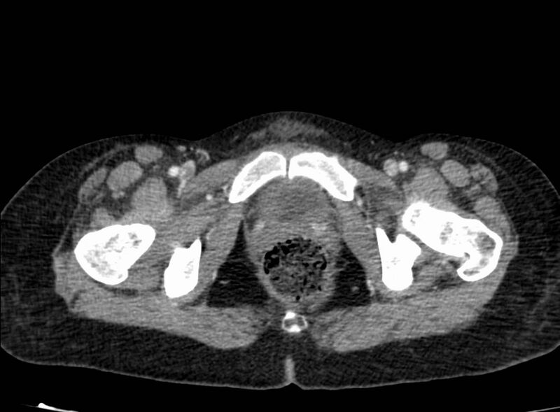 File:Acute Budd-Chiari syndrome (Radiopaedia 60858-68638 Axial C+ portal venous phase 298).jpg