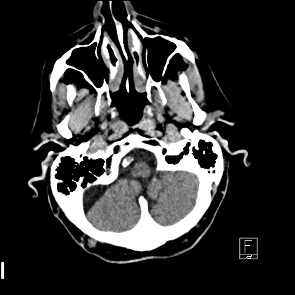 File:Acute ICA ischemic penumbra due to high-grade CCA stenosis (CT perfusion) (Radiopaedia 72038-82529 Axial non-contrast 4).jpg