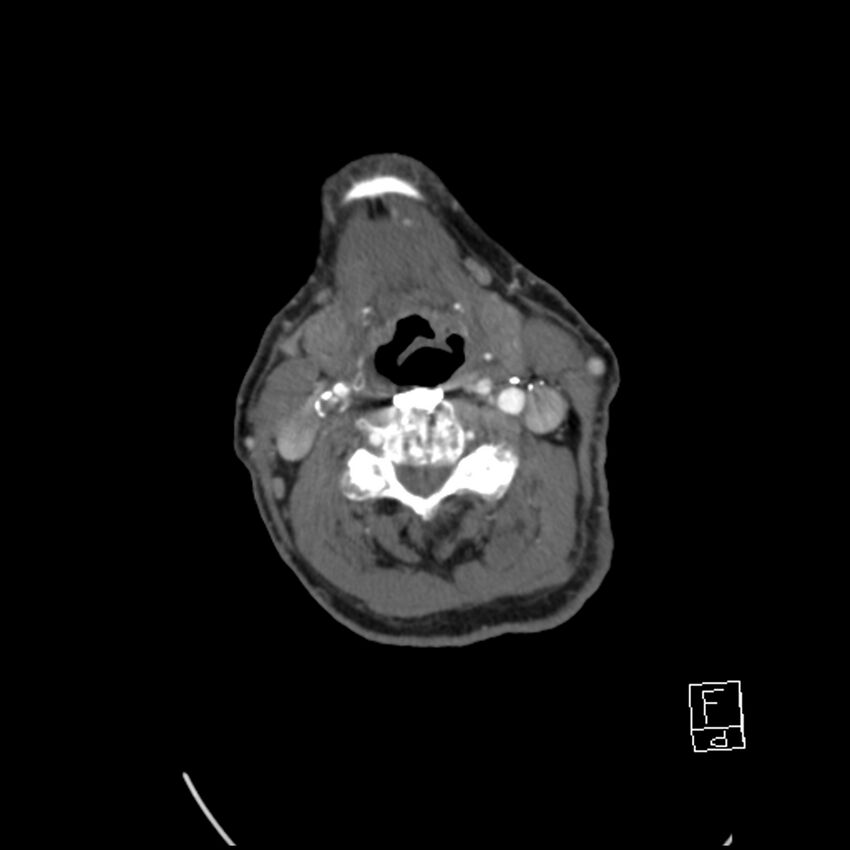 Acute ICA ischemic penumbra due to high-grade CCA stenosis (CT perfusion) (Radiopaedia 72038-82530 Axial C+ arterial phase 43).jpg