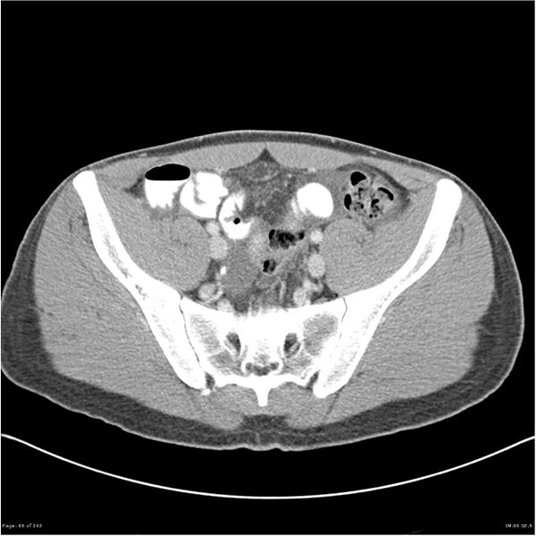 File:Acute appendicitis (Radiopaedia 25364-25615 B 56).jpg