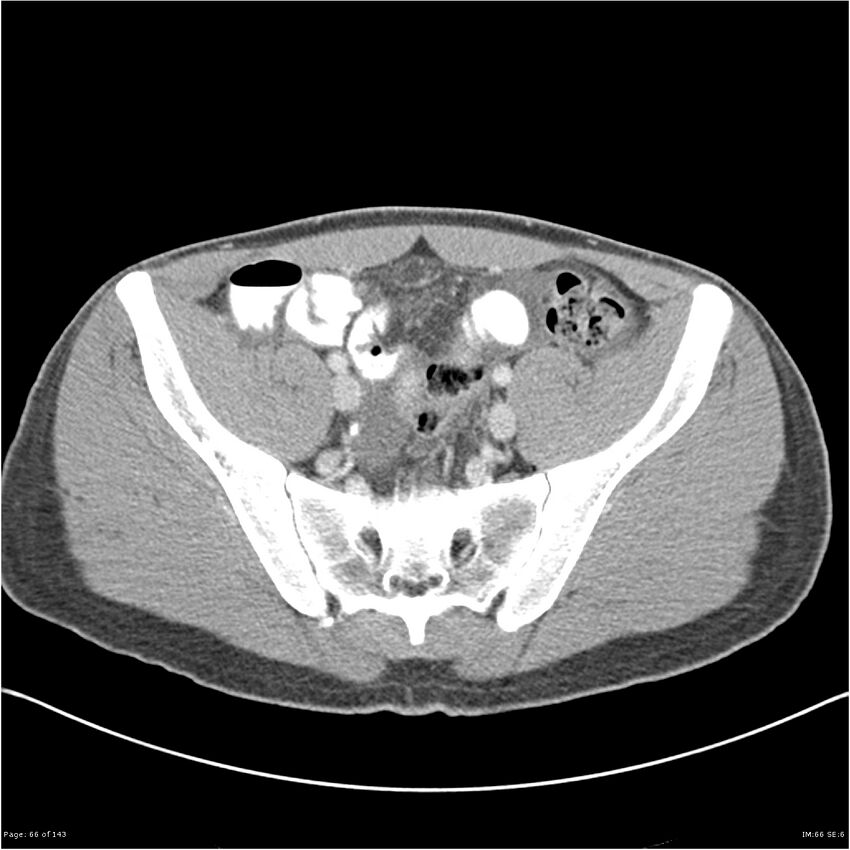 Acute appendicitis (Radiopaedia 25364-25615 B 56).jpg