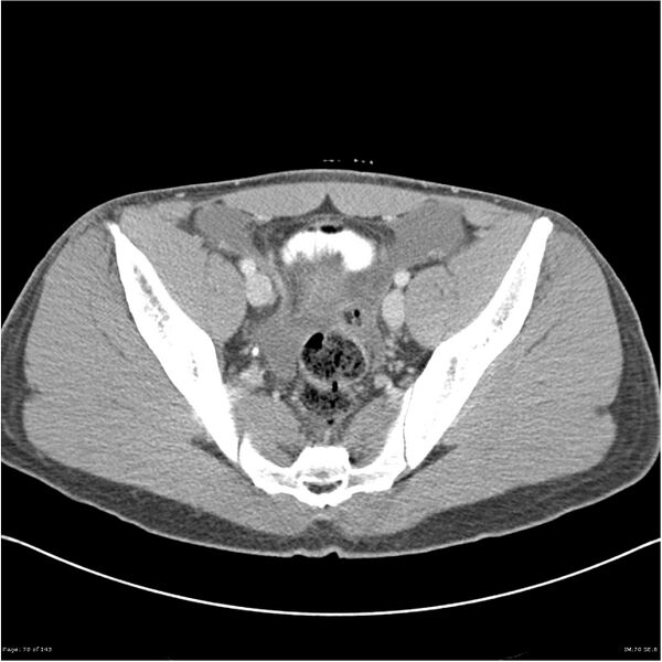 File:Acute appendicitis (Radiopaedia 25364-25615 B 60).jpg