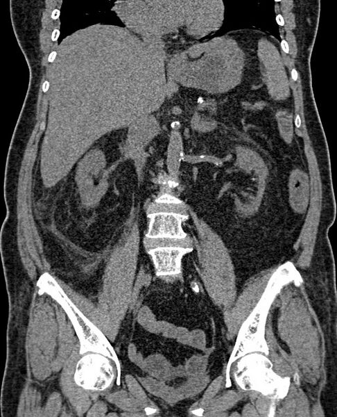 File:Acute appendicitis (Radiopaedia 58627-65818 Coronal non-contrast 42).jpg