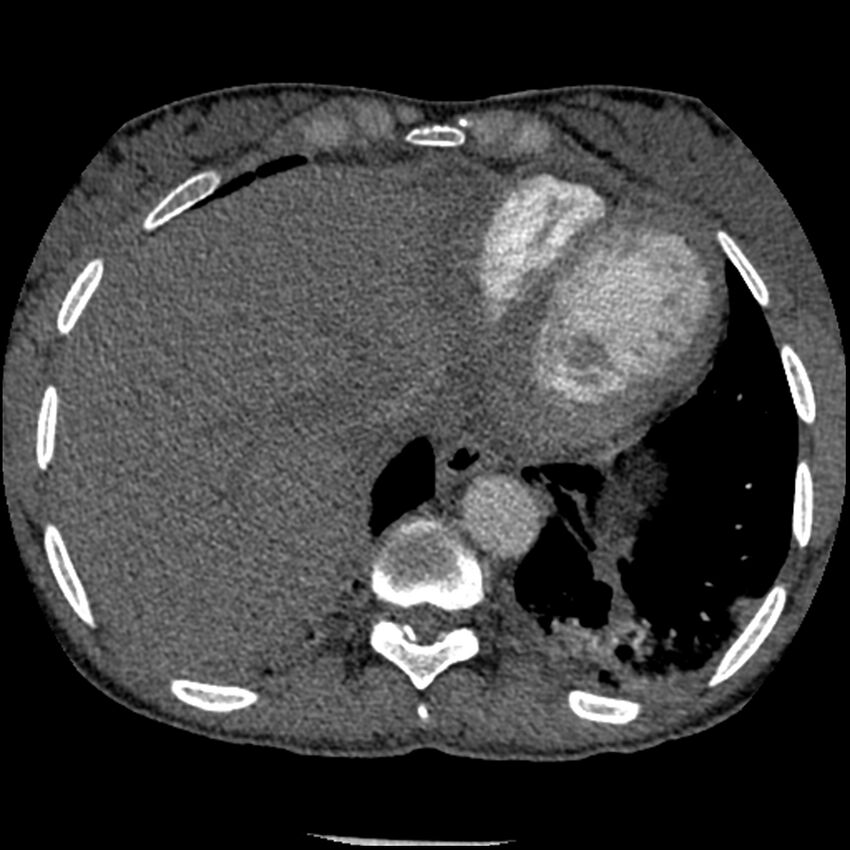 Acute chest syndrome - sickle cell disease (Radiopaedia 42375-45499 Axial C+ CTPA 155).jpg