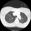 Acute chest syndrome - sickle cell disease (Radiopaedia 42375-45499 Axial lung window 51).jpg