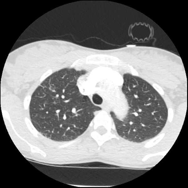 File:Acute chest syndrome - sickle cell disease (Radiopaedia 42375-45499 Axial lung window 51).jpg