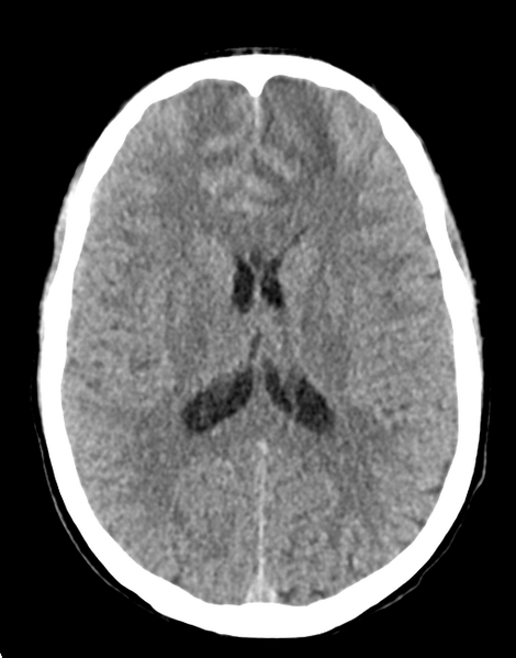 File:Acute disseminated encephalomyelitis (ADEM) (Radiopaedia 65319-74348 Axial non-contrast 19).png