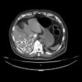 Acute heart failure (CT) (Radiopaedia 79835-93075 Axial C+ arterial phase 73).jpg